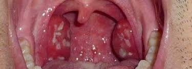 As bolinhas brancas na garganta, também chamados de cáseos ou